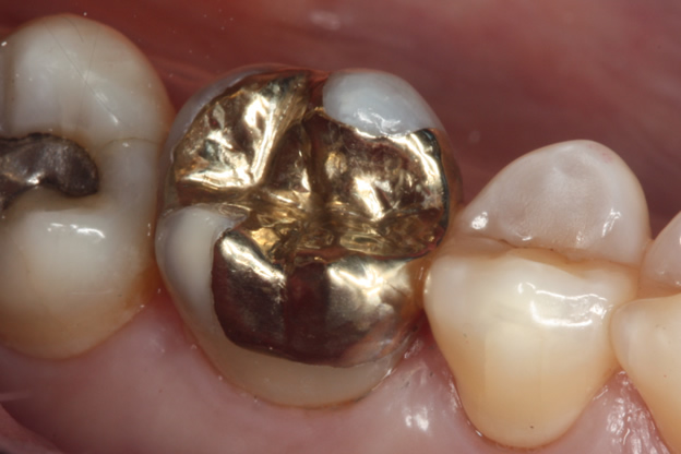 Gold dental crown inside patient’s mouth highlighting value to sell dental gold.