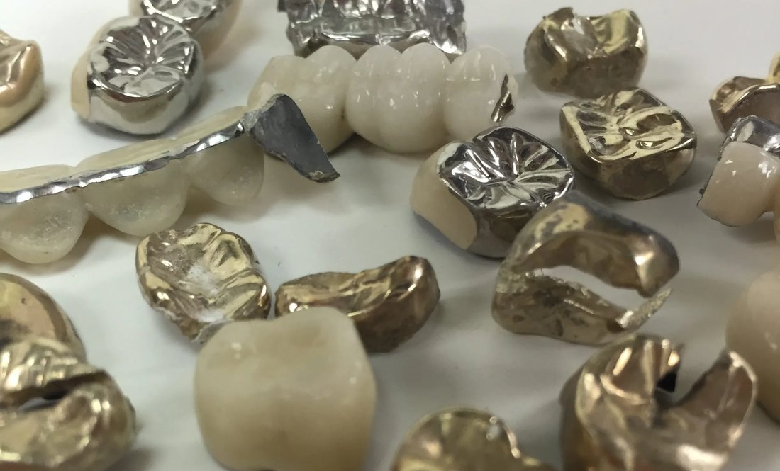 Cast dental metals in gold and base metal alloy — guide to selling gold dentures